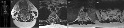 Stereotactic Body Radiotherapy (SBRT) for Oligometastatic Spine Metastases: An Overview